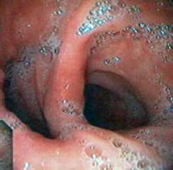 Anastomosi Gastro Digiunale Billroth2
