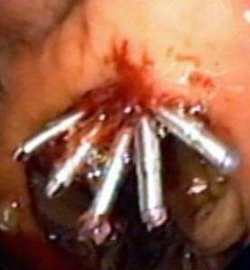 Emorragia Ulcera Gastrica Emostasi Mediante Clips