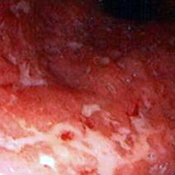 Rettocolite Ulcerosa In Fase Attiva
