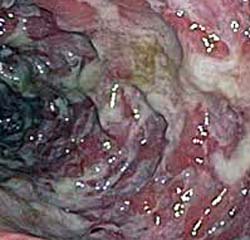Rettocolite Ulcerosa Severa 2