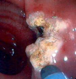 Ulcera Gastrica Sanguinante Emostasi Mediante Argon