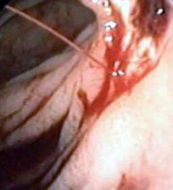 Ulcera Gastrica Sanguinante Forrest 1a 2