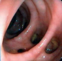 Diverticolosi Colon 1