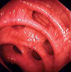 Diverticolosi Sigma